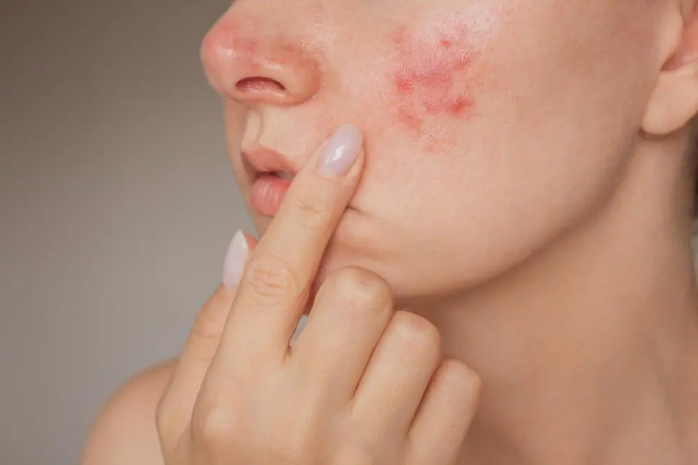 exces-sebum